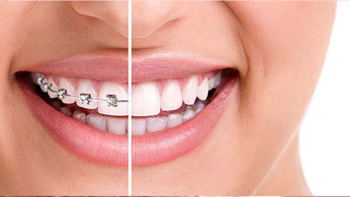 Braces_Image