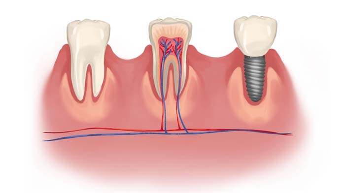 dental_implant