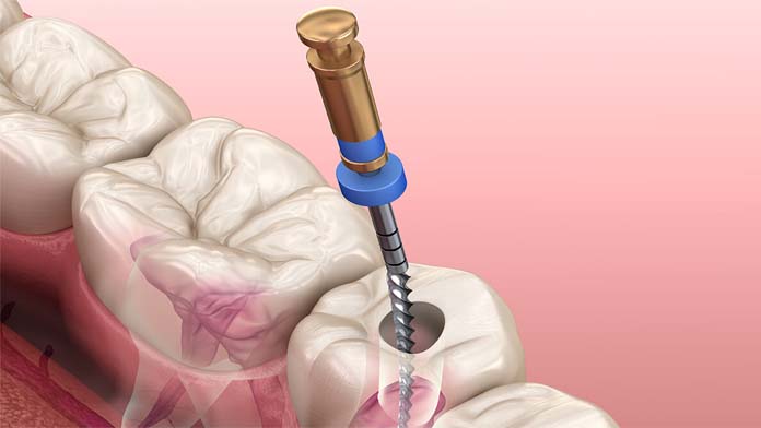 root_canal